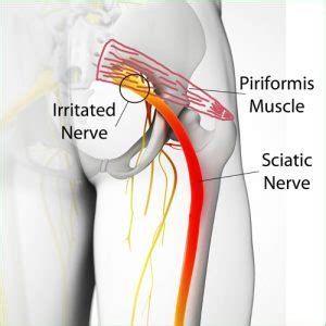 Piriformis Syndrome Explained Cole Pain Therapy Group