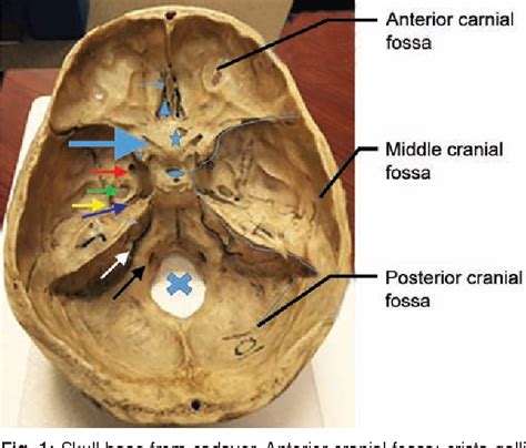 Figure 1 From The Pediatric Anterior Skull Base An Otolaryngologists