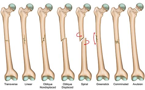 Bone Fracture Types Medical Vector Illustration Stock Illustration