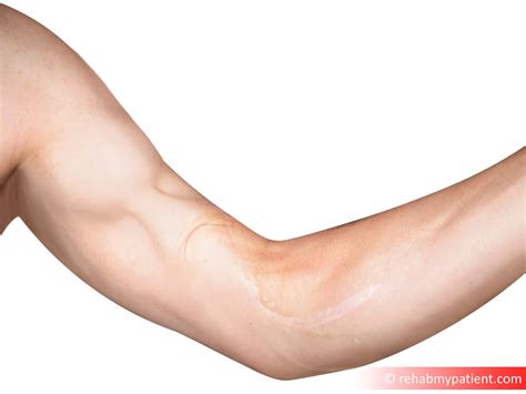Biceps Tendon Anatomy