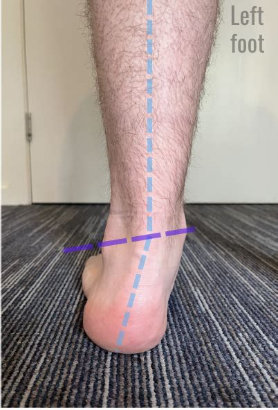 Foot Mechanics Pronation And Supination — Rockhopper Osteopathic Clinic
