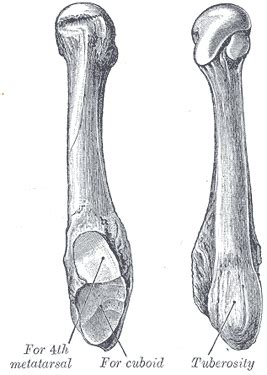 Jones fracture - Wikipedia