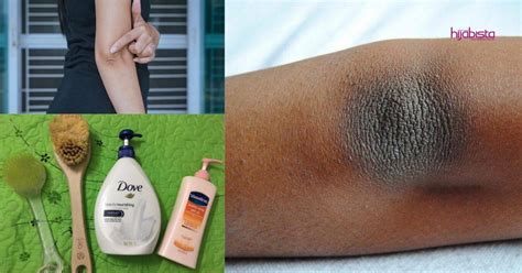 Maka pada hari sabat, seseorang tidak boleh membalut bahagian badan yang terseliuh atau memulihkan tulang yang patah kerana situasi ini tidak akan menyebabkan kematian. Berkerak, Hitam & Berdaki, Wanita Ini Kongsi Cara Cerahkan ...