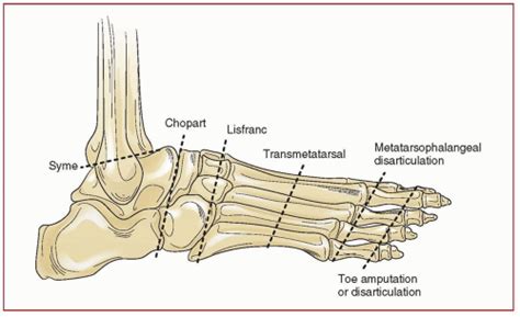 Midfoot Amputations Musculoskeletal Key