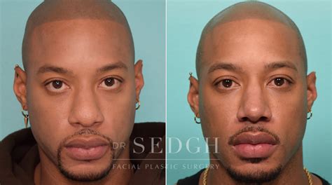 African American Rhinoplasty Before And After Dr Sedgh