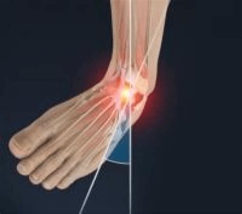 Ankle Sprain Or Ligament Injury Bunbury Foot And Ankle Surgeon