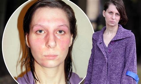 Woman Allergic To Nearly Everything Says She Is A Prisoner In Her