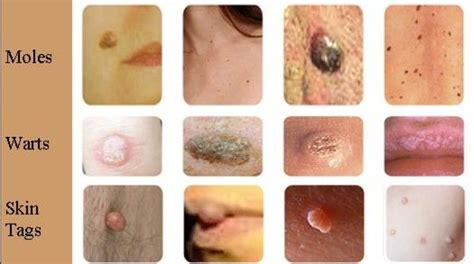 Skin Tags Versus Warts Facial Warts Skin Tag Skin Tag Removal