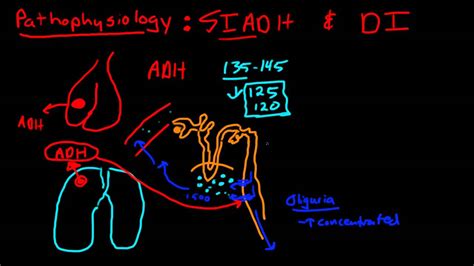 Hyponatremia secondary to siadh improves with the treatment of the underlying cause, thus an therefore, the most likely cause of the hyponatremia is siadh, a diagnosis further corroborated by. SIADH & DI - YouTube