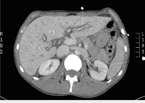 Ct Abdomen And Pelvis With Iv Contrast Demonstrating Periportal Edema