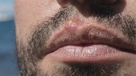 Herpes On Lips Causes Cheapest Buy Save 61 Jlcatjgobmx