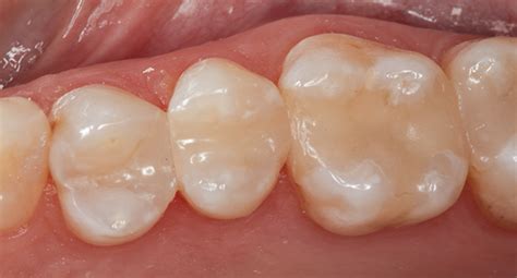 Direct Composite Restorations In The Posterior Region March Inside Dentistry