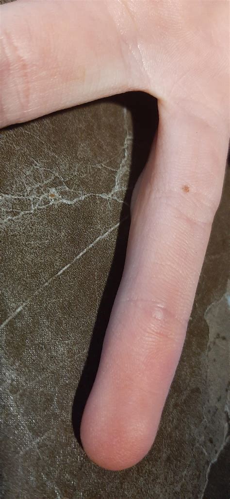 Strange Bump In Ring Finger In Joint Diagnoseme