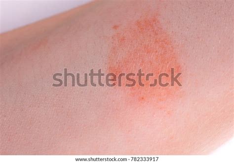 Great Red Spot On Skin Closeup Stock Photo 782333917 Shutterstock