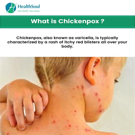 Chickenpox Treatment
