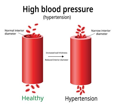 How High Or Low Blood Pressure Increases The Risk Of Dementia And Why