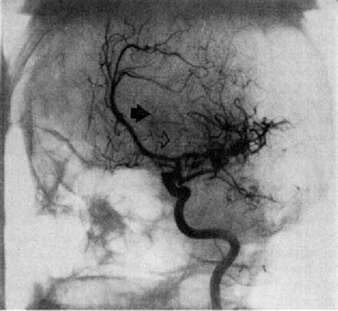 Figure 3 From Fibromuscular Dysplasia Of Intracranial Arteries In A