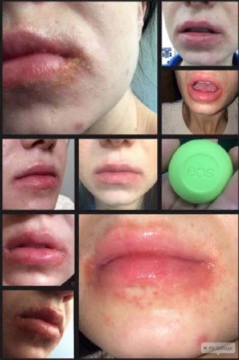 Eos Lip Balm May Cause Blisters And Rashes Lawsuit Attn