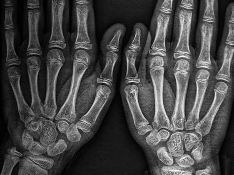 X Rays Getty Images Istock By Getty Images Arcangel I Flickr
