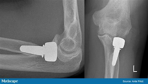 Total Elbow Replacement What You Need To Know Toca The Orthopedic