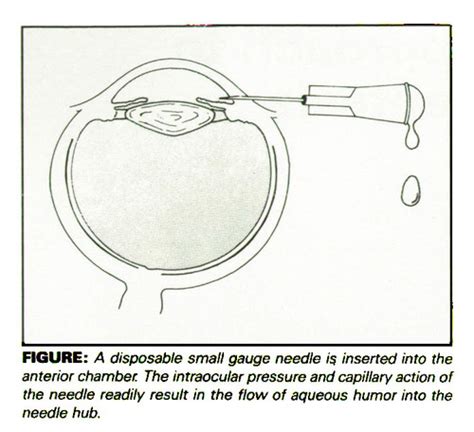 Paracentesis Eye