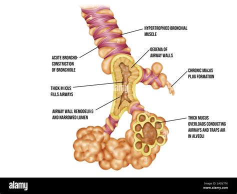 Lung Bronchioles And Alveoli In Bronchiolitis Illustration