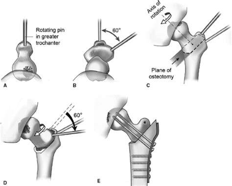 Femoral Head Osteonecrosis—proximal Femoral Osteotomy And Open Bone