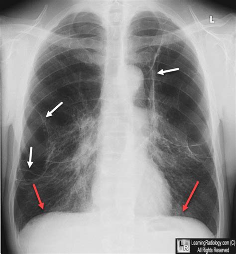 Learning Radiology Bullous Disease Of The Lungs