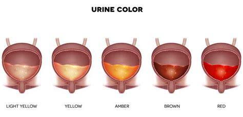 Blood in urine, medically termed 'hematuria' may or may not be a serious problem. "Normal" Urine Color: 50 Shades of Yellow - University ...