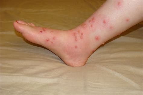 The Perils of Summer: Poison Ivy and Poison Oak