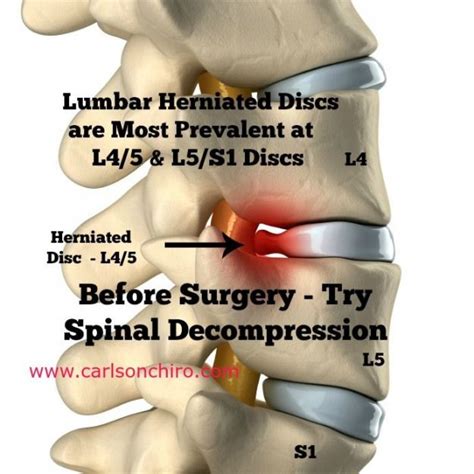 Backpain Herniated Disc Spinal Decompression Herniated