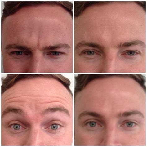 Frown Lines Treatment Get Rid Of Frown Lines With Filler And Wrinkle