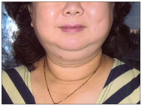 Anatomi secara anatomi, hypofisis cerebri atau glandula pituitari adalah struktur lonjong kecil yang melekat pada askep tumor hipofisis posterior. Penyakit Cushing Syndrome Apa Penyebabnya? - Kondisi Umum