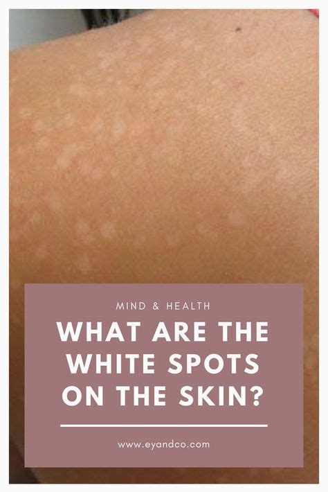 What Are The White Spots On The Skin With Images White Skin Spots