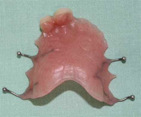 2 Plastic Partial Denture Replacing Front Teeth