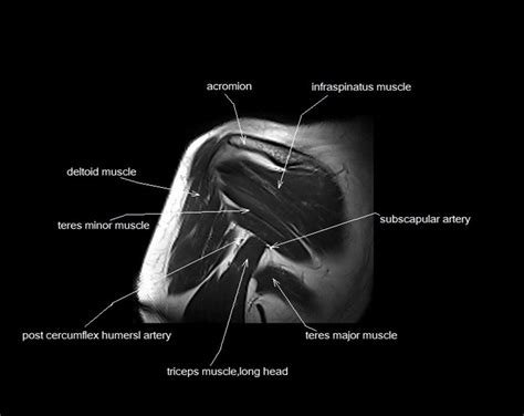 This section of the website will explain large and minute details of sagittal knee cross sectional anatomy. MRI shoulder anatomy | shoulder coronal anatomy | free ...