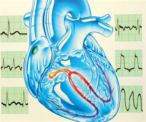 Arrhythmias — Overview Of The Condition The Pharmaceutical Journal