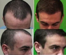 Hairline recession is one of the main reasons people go for a hair transplant in pune. Hairline Recession - DermHair Clinic Los Angeles 1-310-318 ...