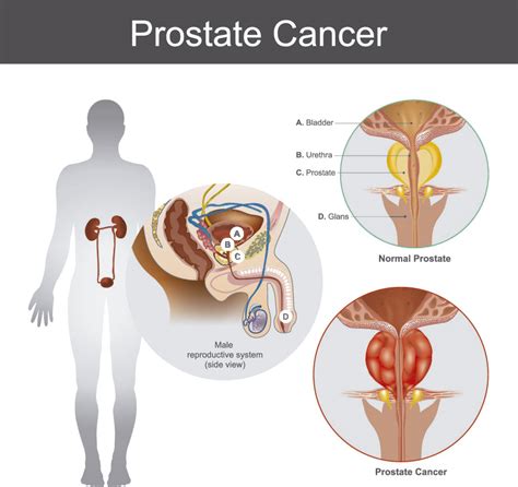 Conozca Todo Sobre El Cancer De Prostata Causas Sintomas Diagnostico Y