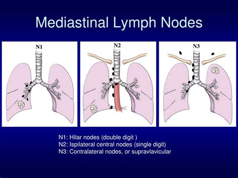 Anterior Mediastinal Lymph Node