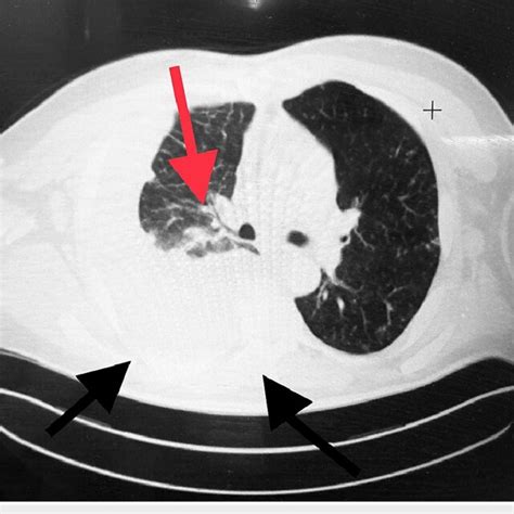 Chest Ct With Intravenous Contrast Two Black Arrows Showing Large
