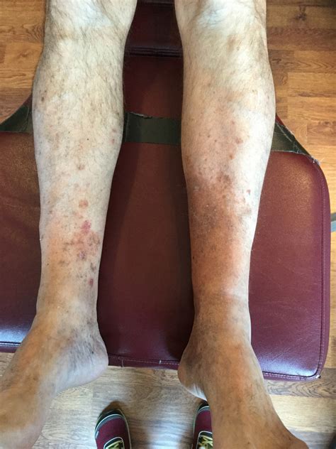 Knee Pain And Hyperpigmentation — The Gait Guys