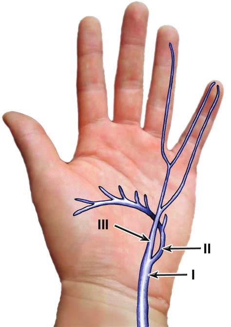 Shea And McClain S Subdivision Of The Lesions Of Ulnar Nerve In The Download Scientific Diagram
