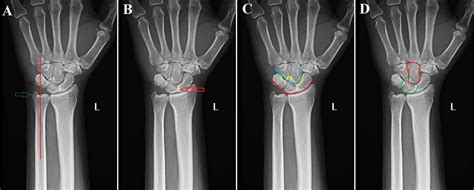 Isolated Lunate Dislocation Bmj Case Reports