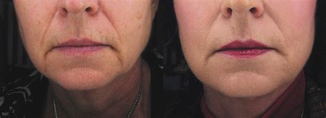 Spectralift Non Surgical Facelift A Facelift Without Surgery