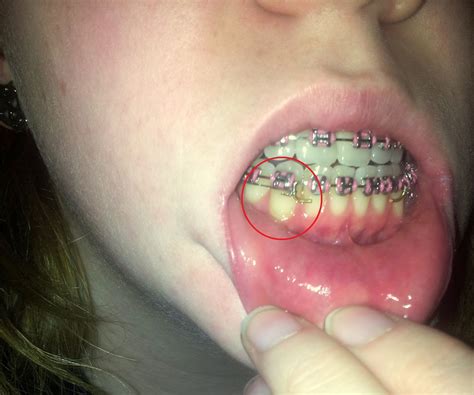 If left untreated, the supporting tissue and bone receding gums is a common dental problem because of its subtle onset. My Jaw Surgery: Receding Gums?????