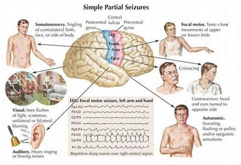 Seizure Info Seizure Symptoms Epilepsy Epilepsy Symptoms