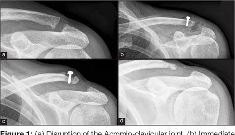 Figure 1 From Distal Clavicle Osteolysis Following Fixation With A