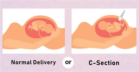 Which Delivery Is Better Normal Delivery Or Cesarean C Section
