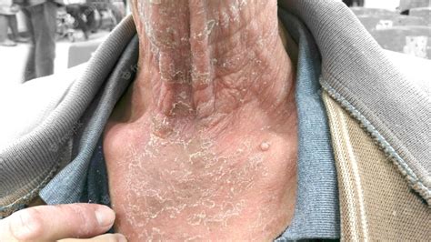 Premium Photo The Infected Skin Begins To Peel Off Fungal Infections Neck